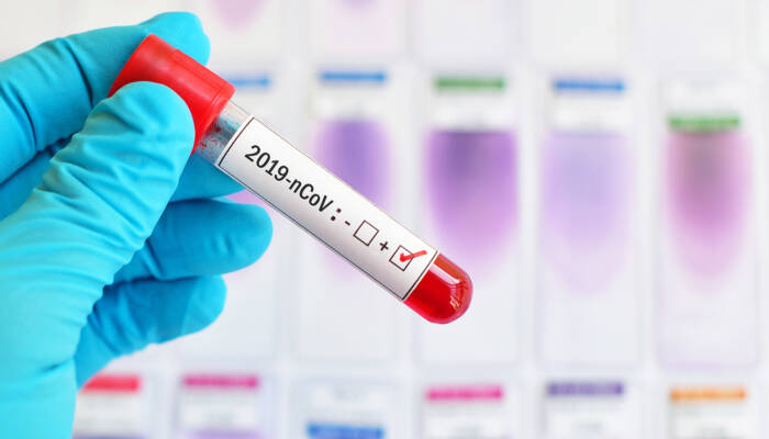 Blood sample tube positive with 2019-nCoV, novel coronavirus 201